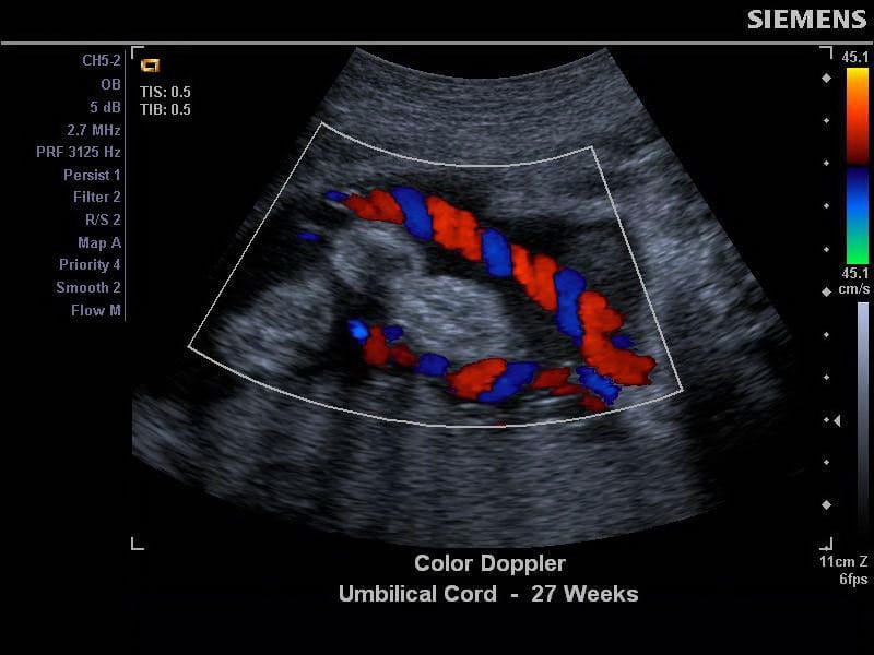 Доплер 2. Ультразвуковое допплеровское картирование. Допплерография фетоплацентарного кровотока. Допплеровская ультразвуковая допплерография почек.. Допплер УЗИ при беременности.